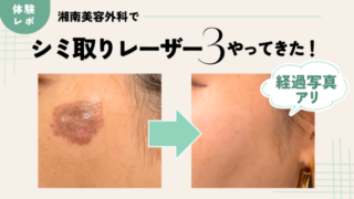 湘南美容外科でシミ取りレーザー3体験談ブログ