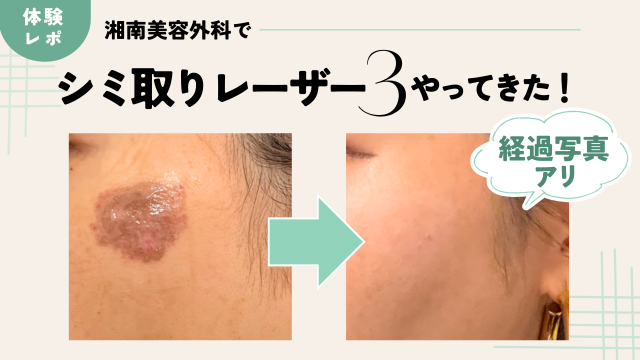 湘南美容外科でシミ取りレーザー3体験談ブログ