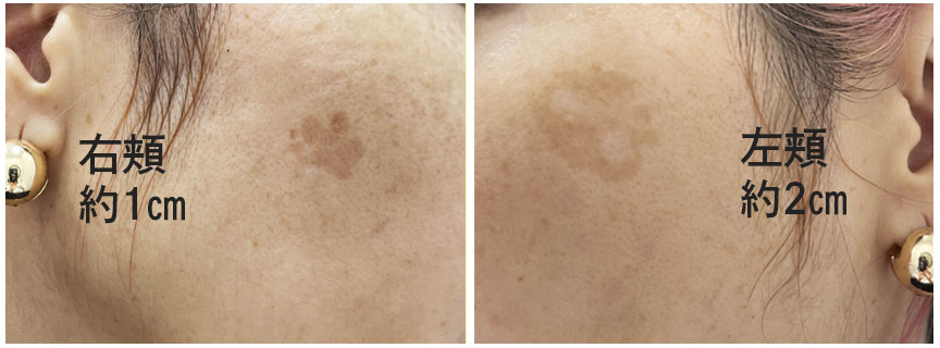 湘南美容外科のシミ取りビフォー