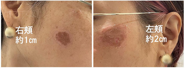 湘南美容外科のシミ取り3の施術直後