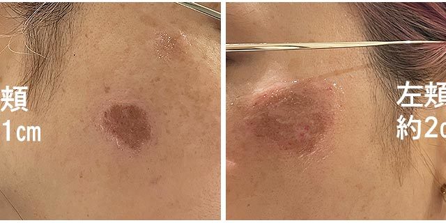 湘南美容外科のシミ取り3の施術直後