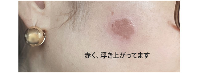 ぷくっと幹部が少し盛り上がってますね。