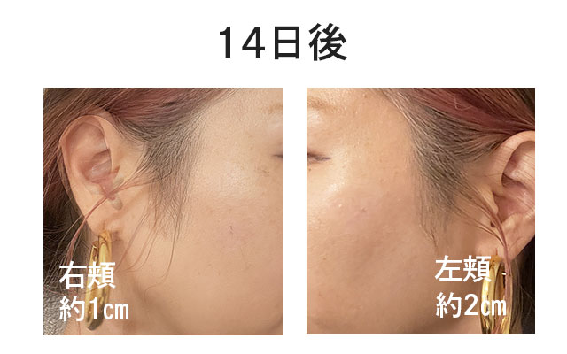湘南美容外科のシミ取り3の施術の14日後